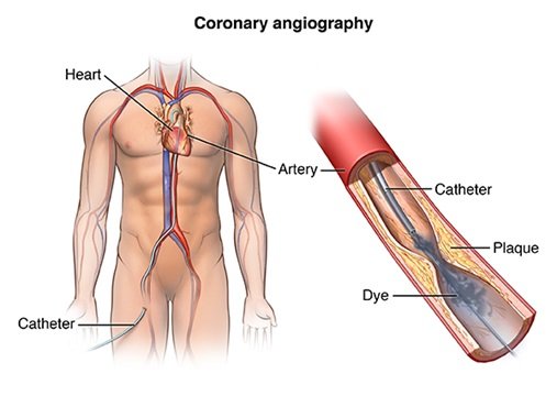 Coronary Angiography (CAG)