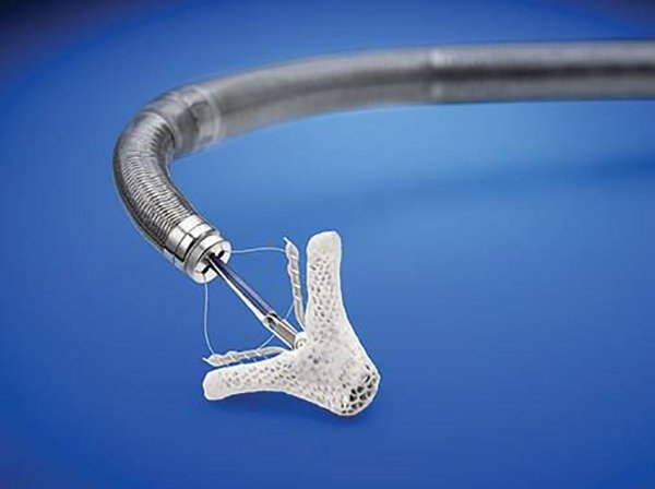 Coronary Angiography (CAG)