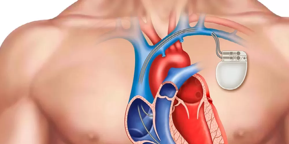Coronary Angiography (CAG)