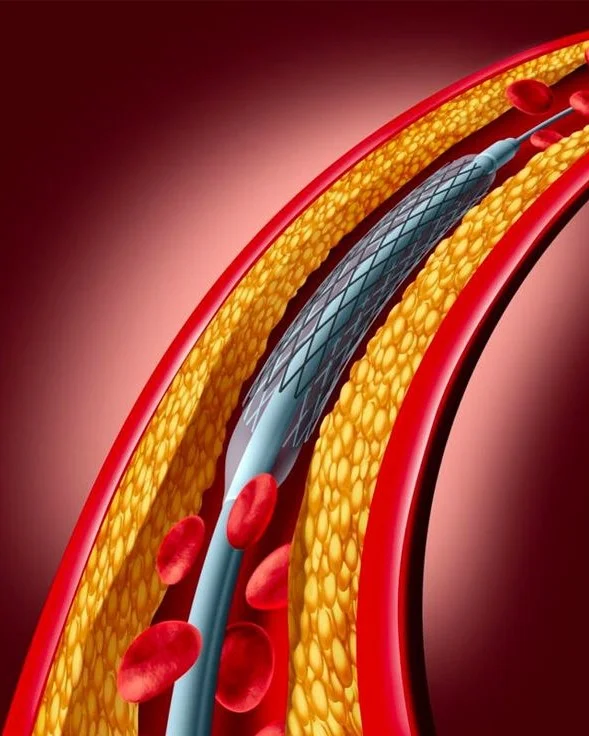 Coronary Angiography (CAG)